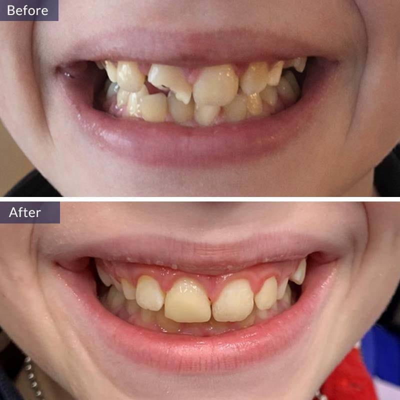 Pediatric dental treatment before and after results for a young patient at VITAdent Brooklyn Dental Group