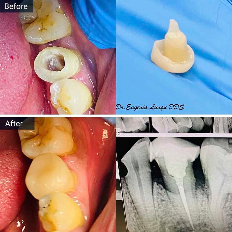Root Canal Procedure Before and After Result