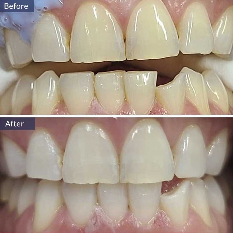 Teeth Cleaning Before and After Results Case 2