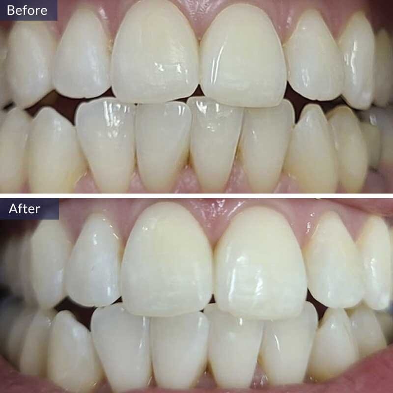 Teeth Cleaning Before and After Results Case 3