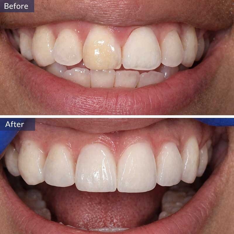 Teeth Cleaning Before and After Results