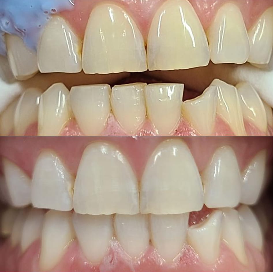 Teeth whitening before and after