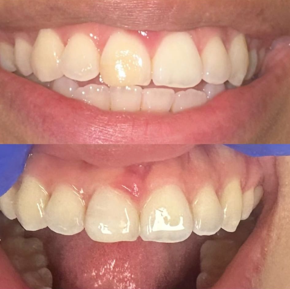 Dental bonding before and after