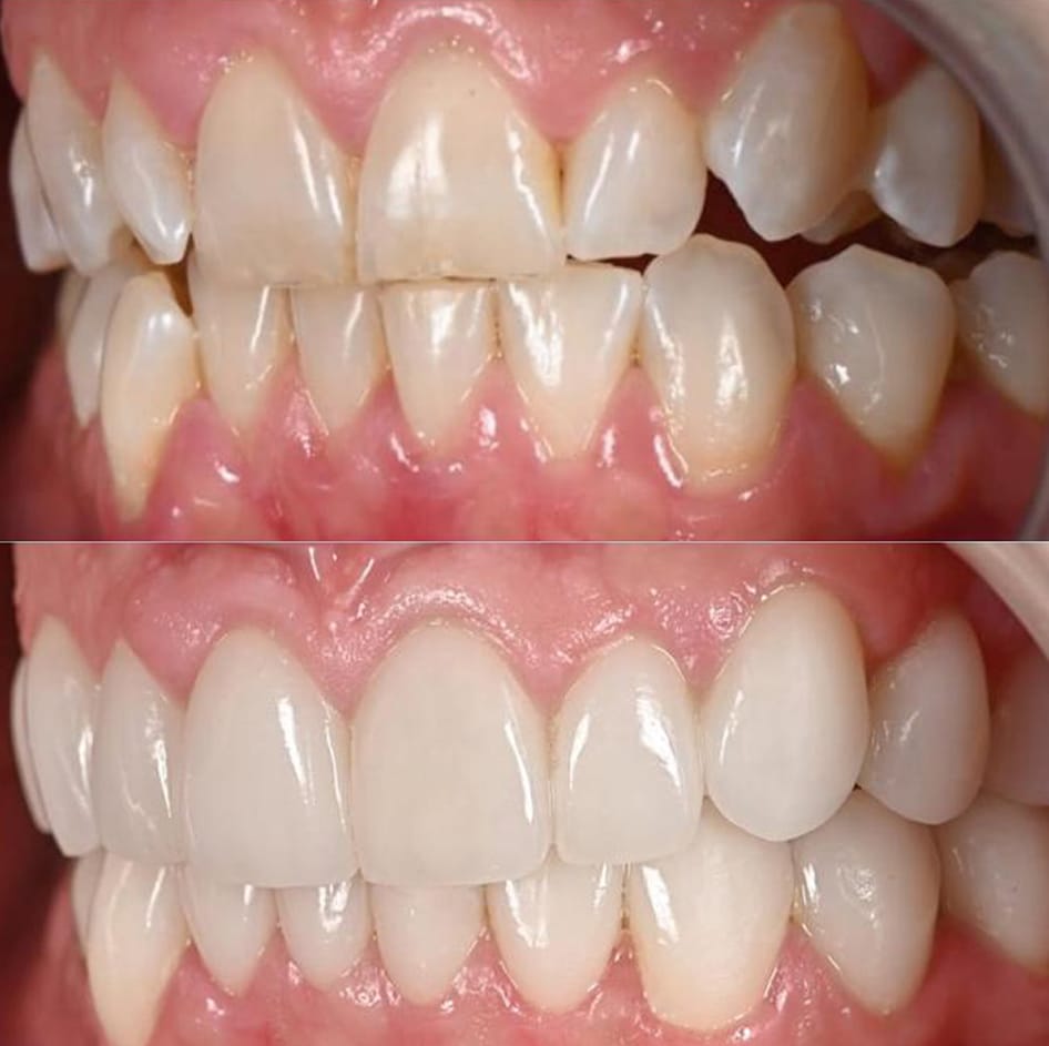 Ceramic laminate – veneers before and after