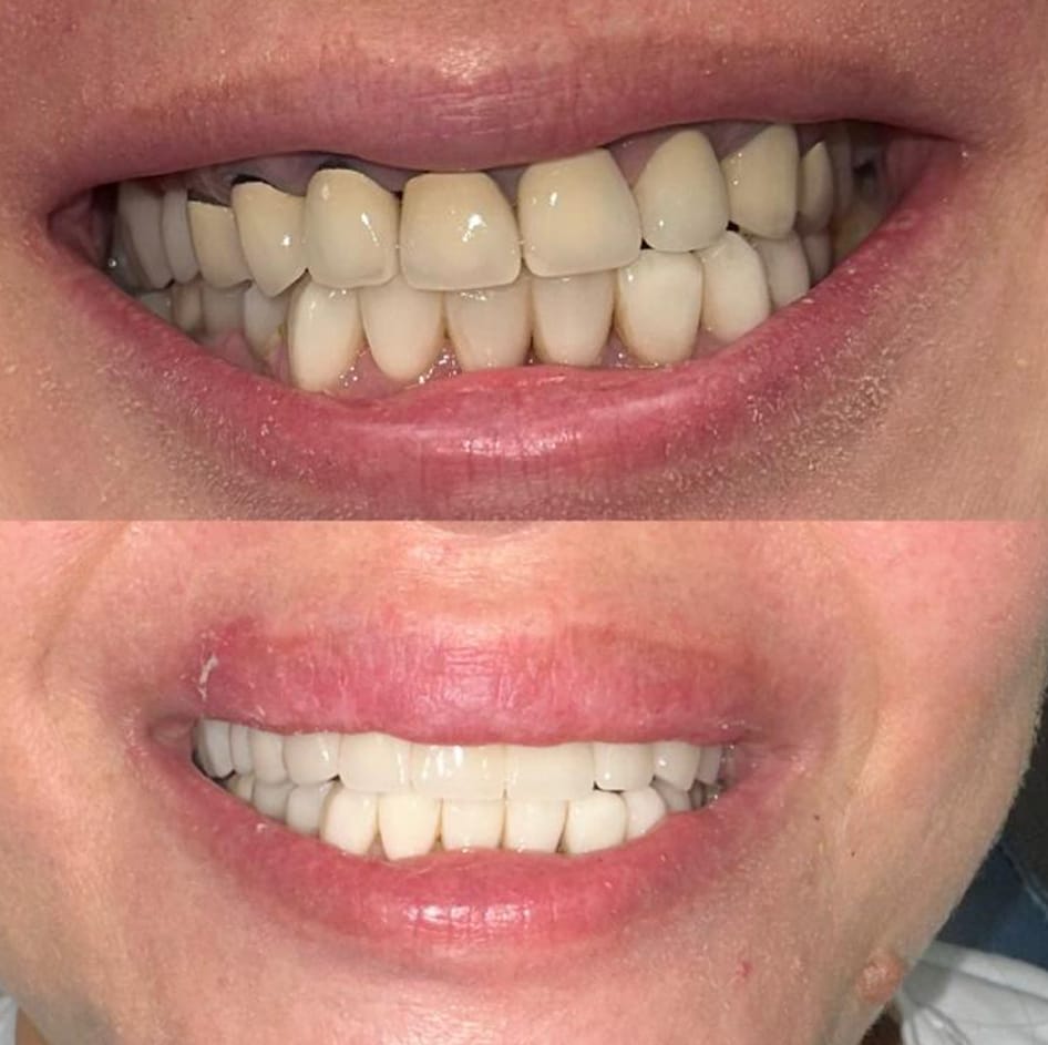 New ceramic rehab before and after