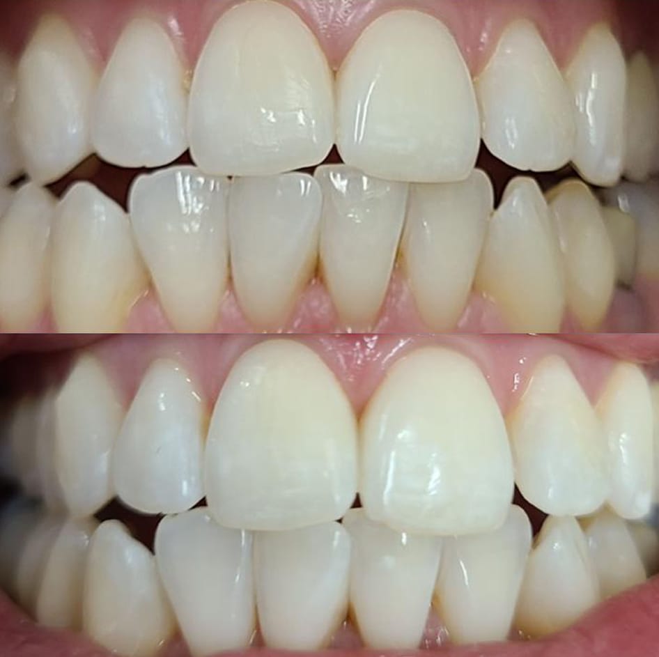 Wakening bleaching before and after