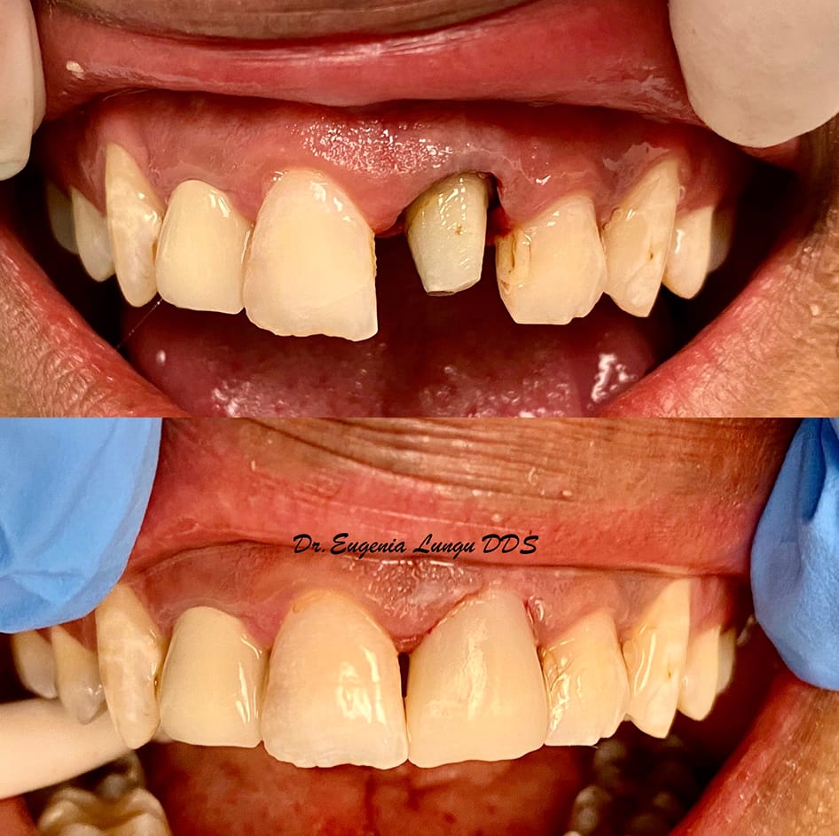 Front tooth ceramic veneer before and after