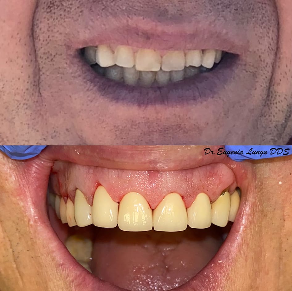 Dental restoration of the front teeth before and after