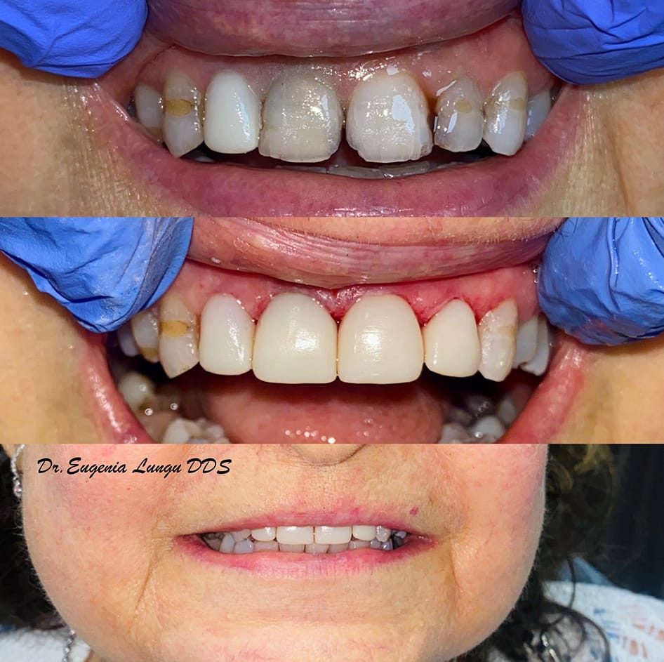 Front tooth veneer before and after