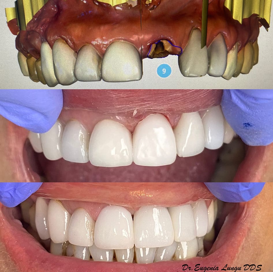 Front tooth implant before and after