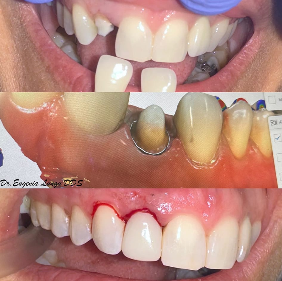 Tooth implants before and after