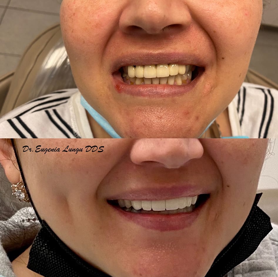 Dental bleaching before and after