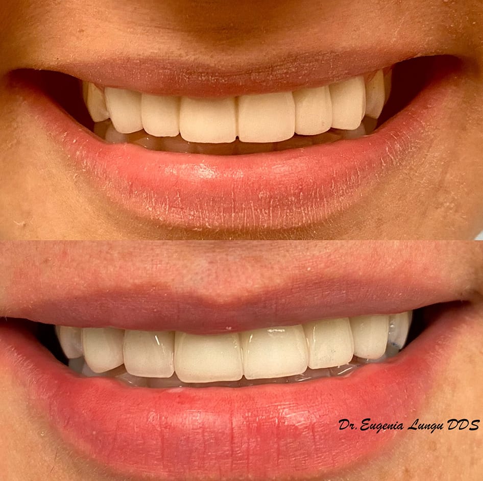 Tooth bleaching before and after