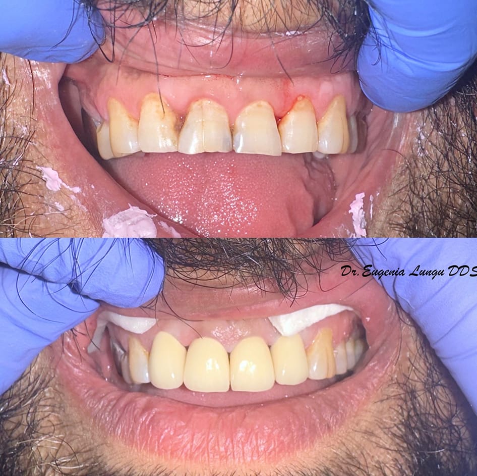 Front tooth crown before and after
