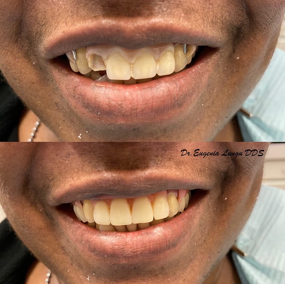 Front tooth dental implant before and after