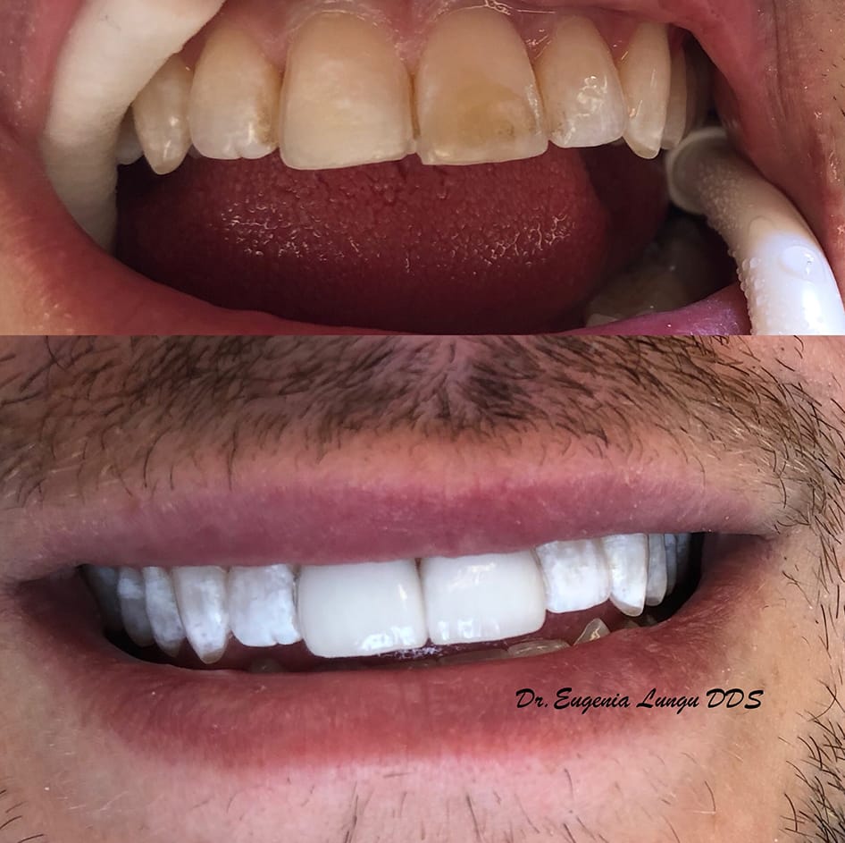 Professional teeth whitening before and after