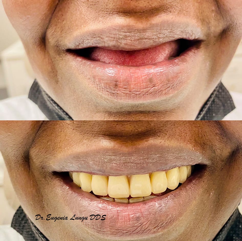 Full arch restoration before and after