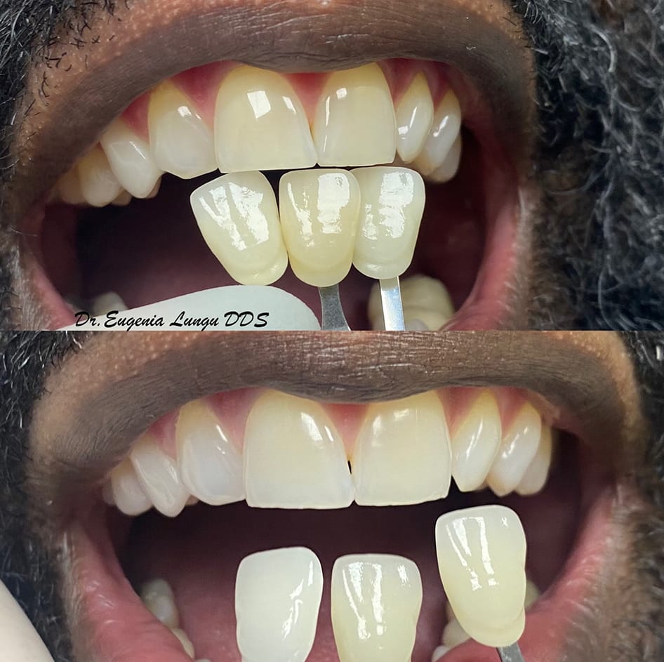 Ceramic veneer before and after