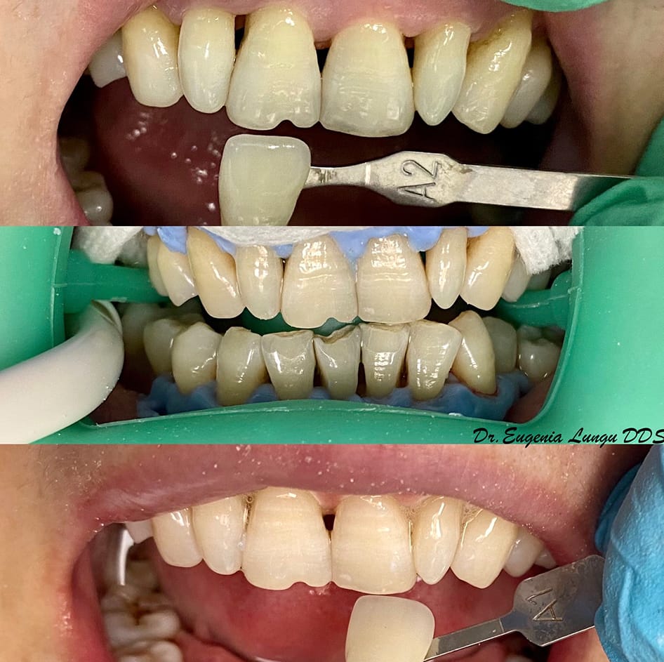 Dental crown before and after