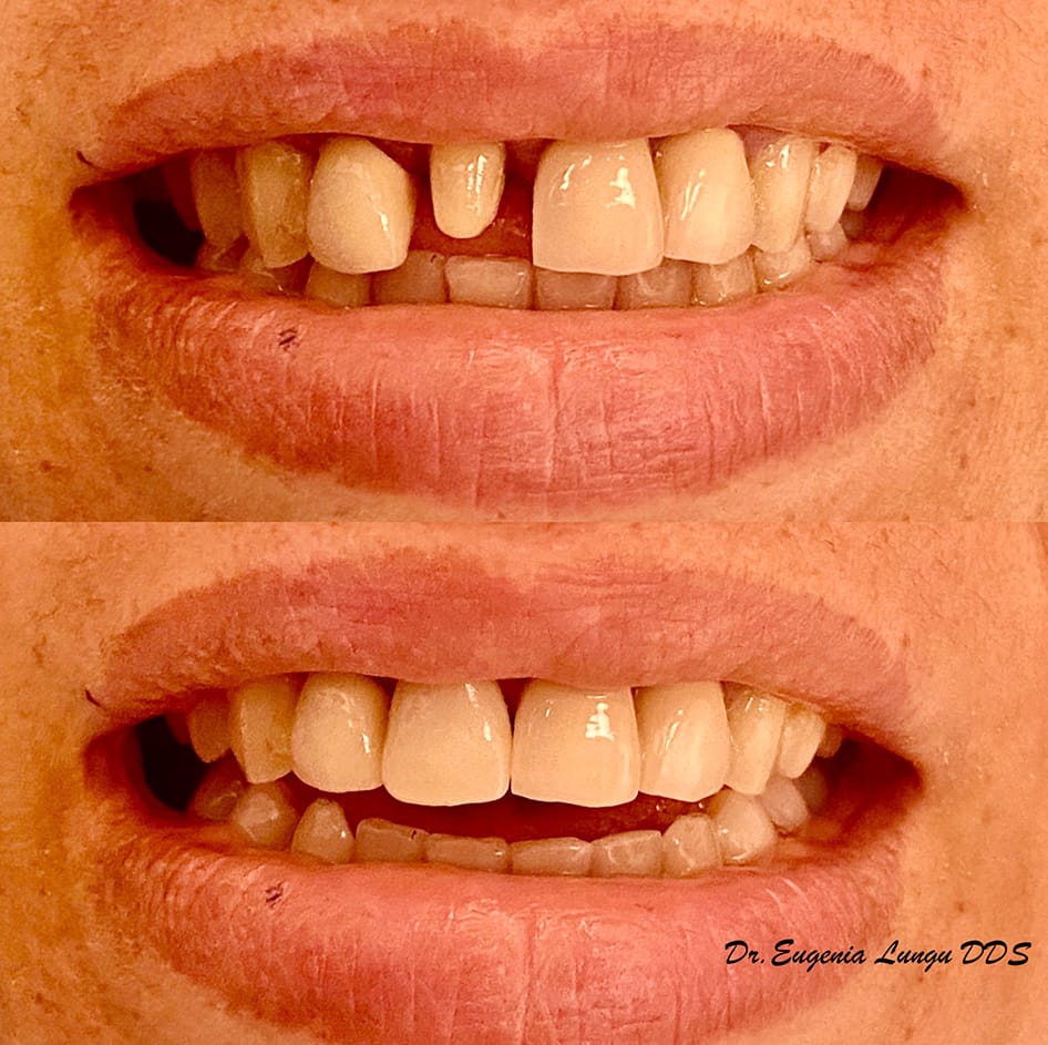 Front tooth restoration before and after