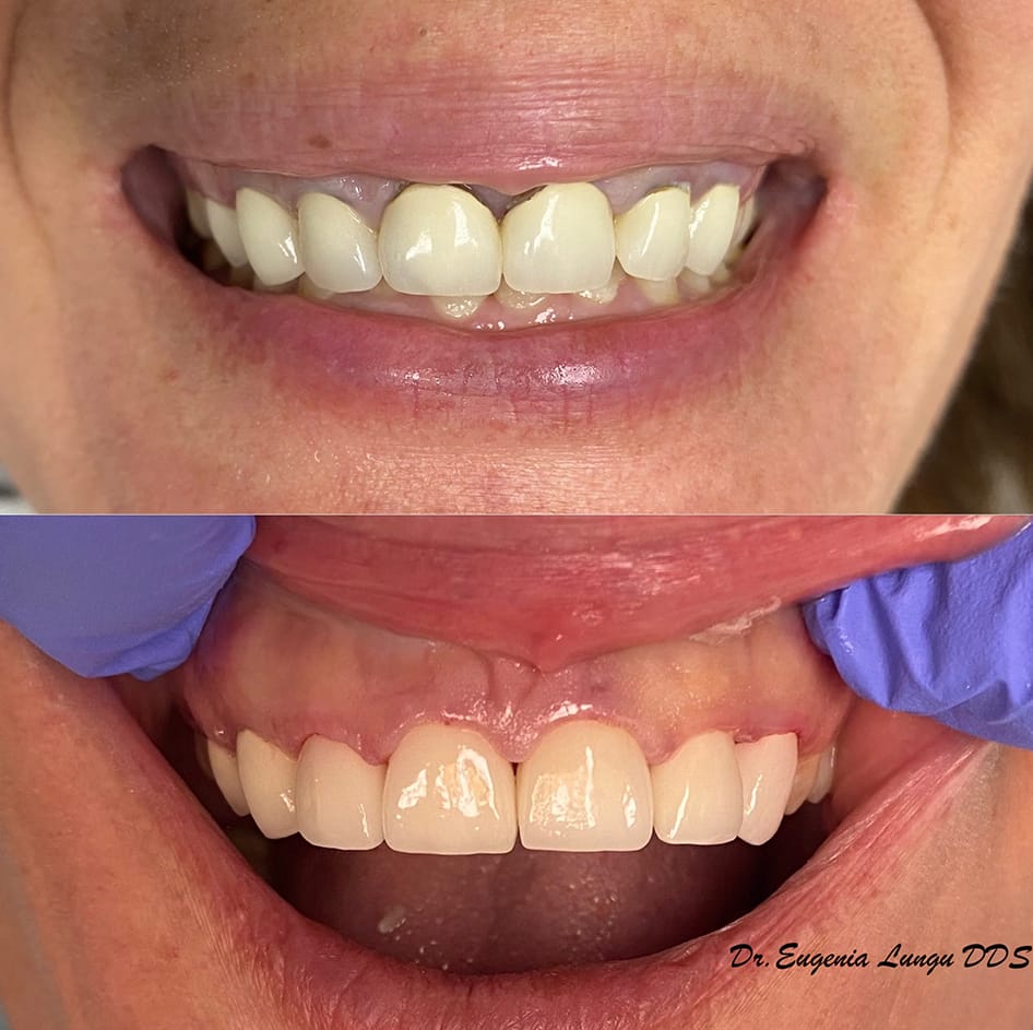 Teeth bleaching before and after