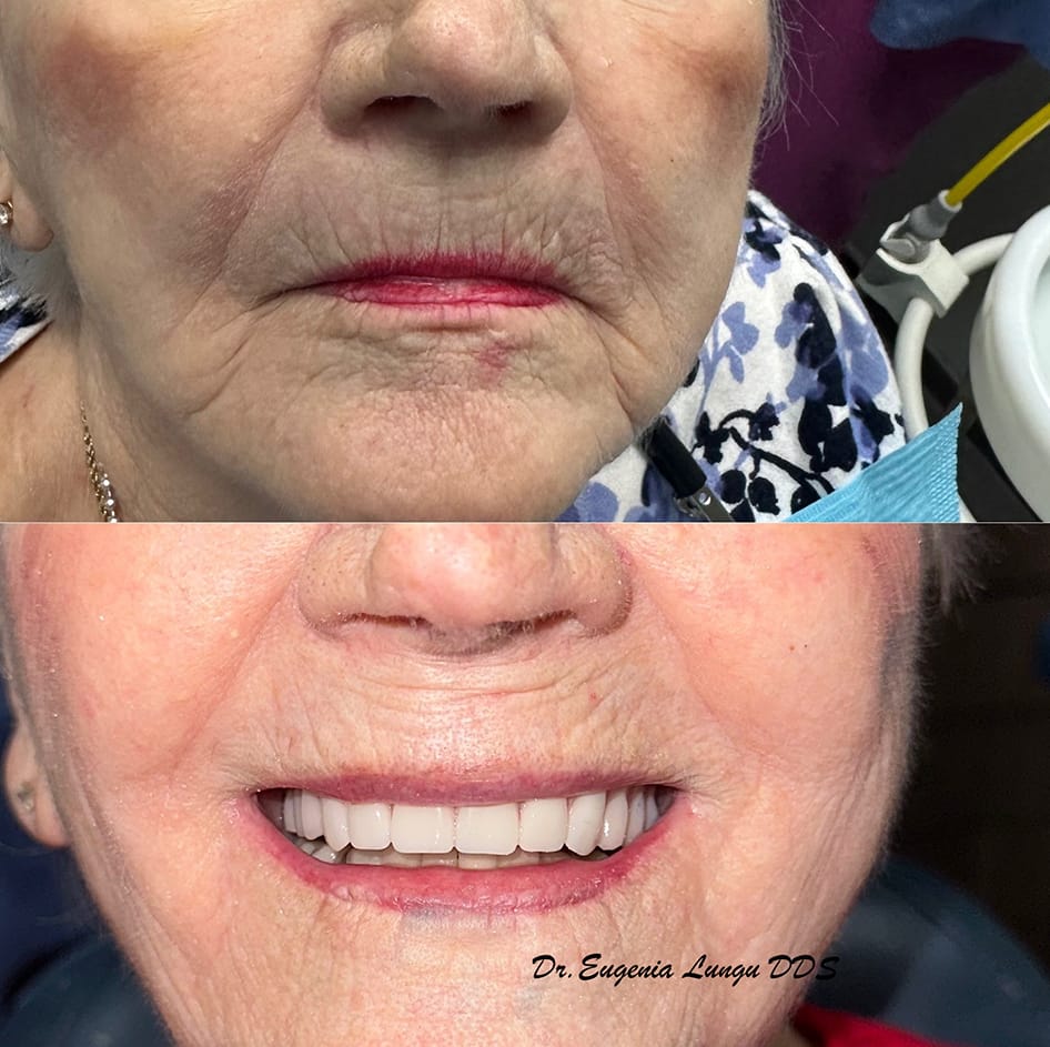 Full mouth restoration before and after