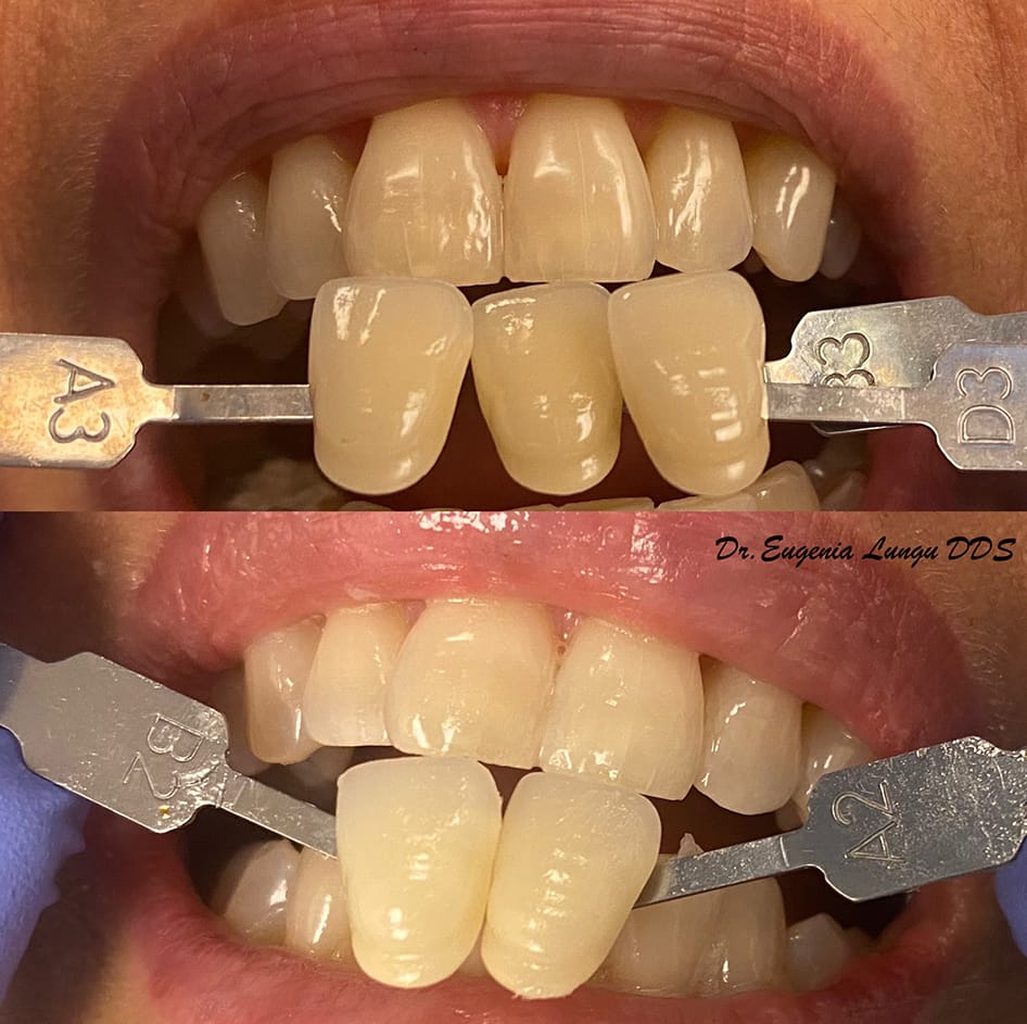 Cosmetic dental veneers before and after