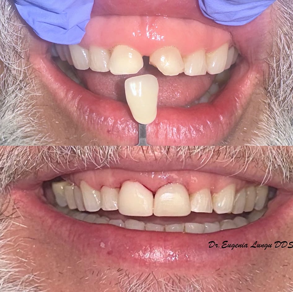 Front tooth dental veneers before and after