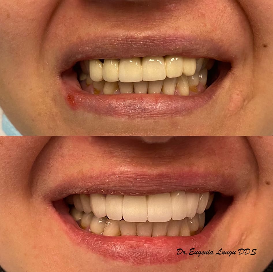 Clinical tooth whitening before and after