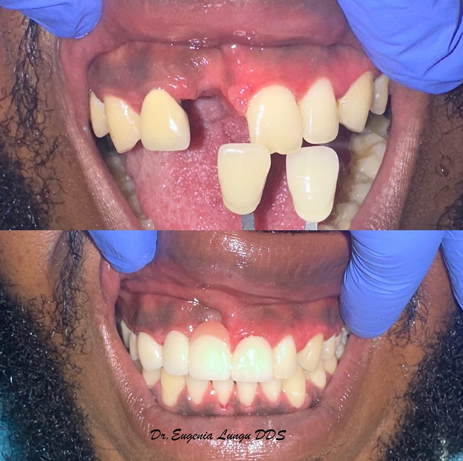 Implant-supported crowns before and after