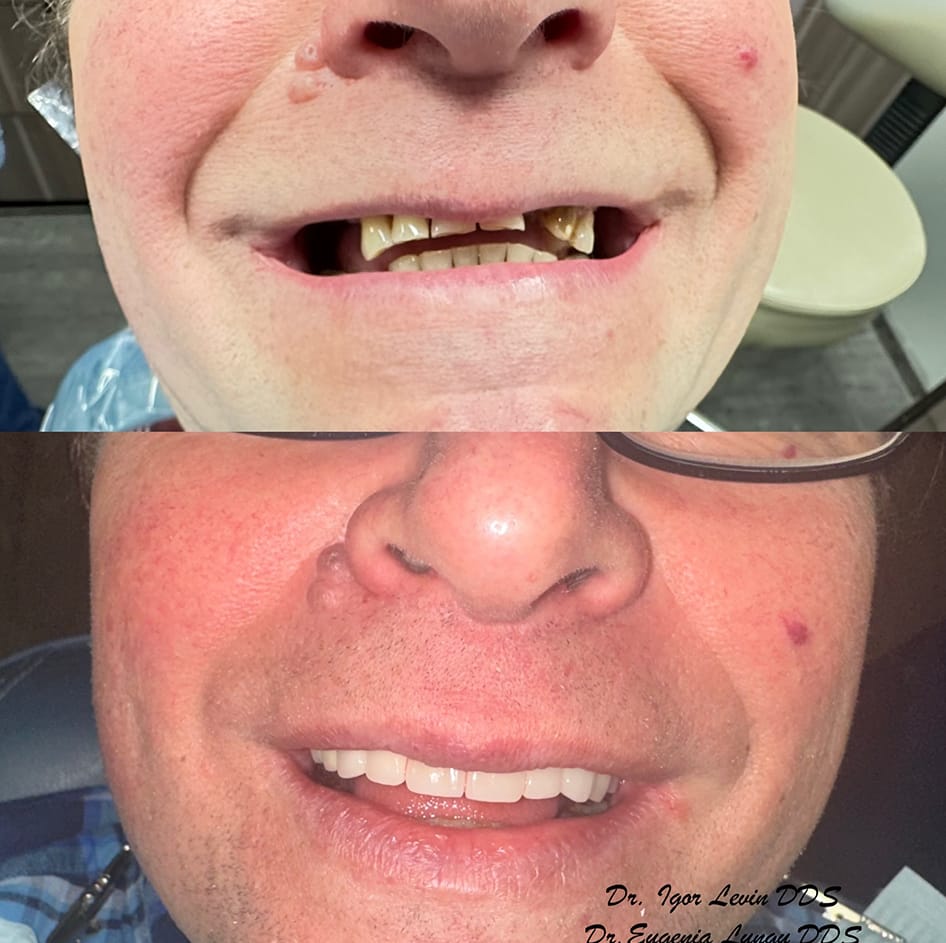 Full mouth reconstruction before and after
