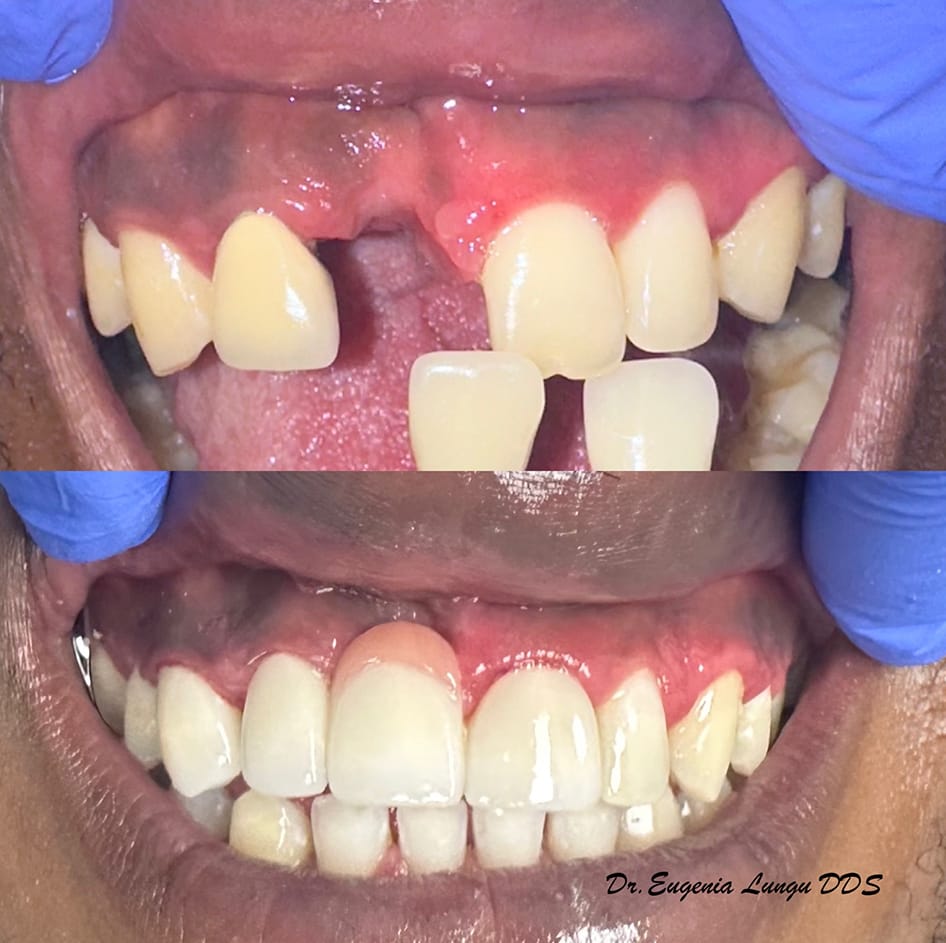 Implant-supported crowns before and after