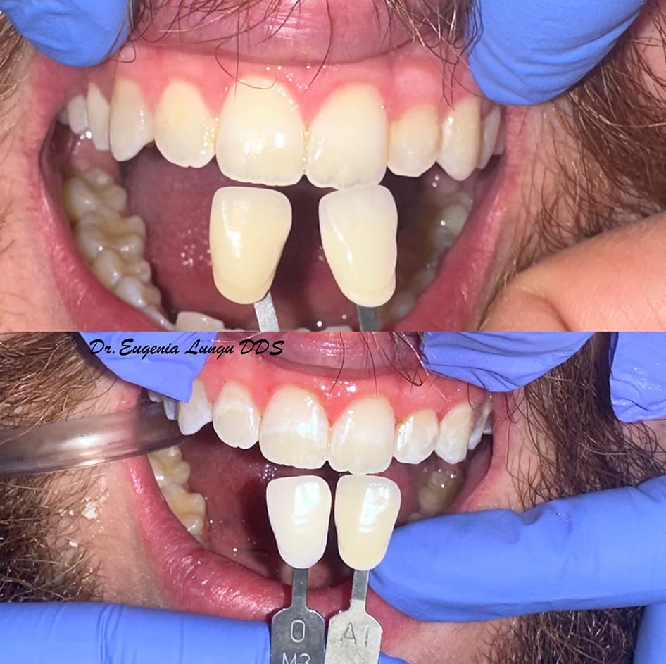 Implant-supported tooth restoration before and after