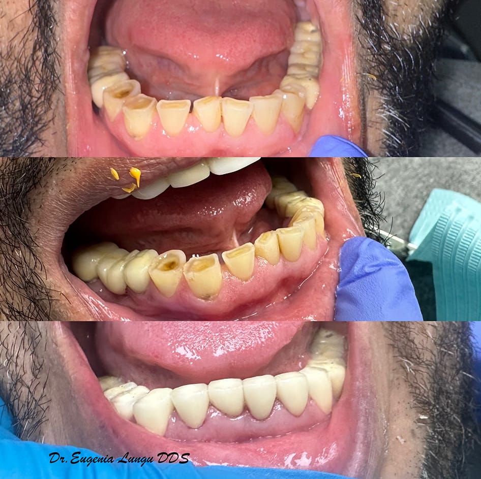 Before and after full mouth reconstruction