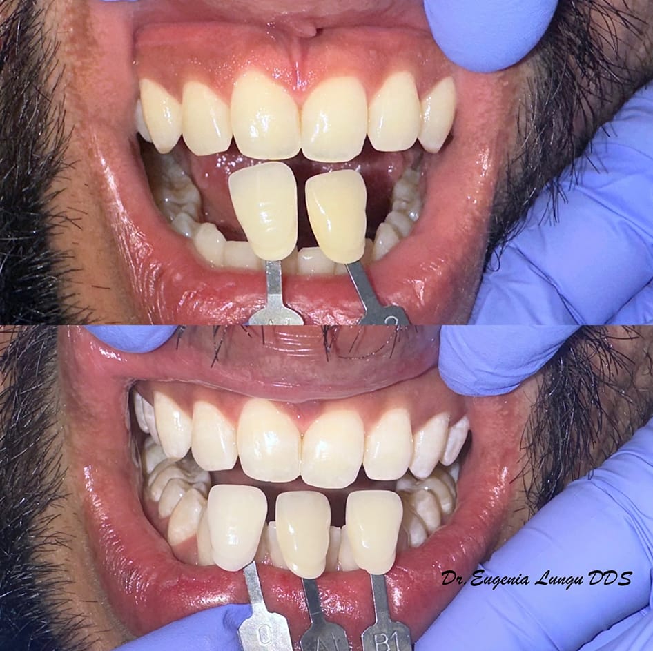 Before and after dental whitening