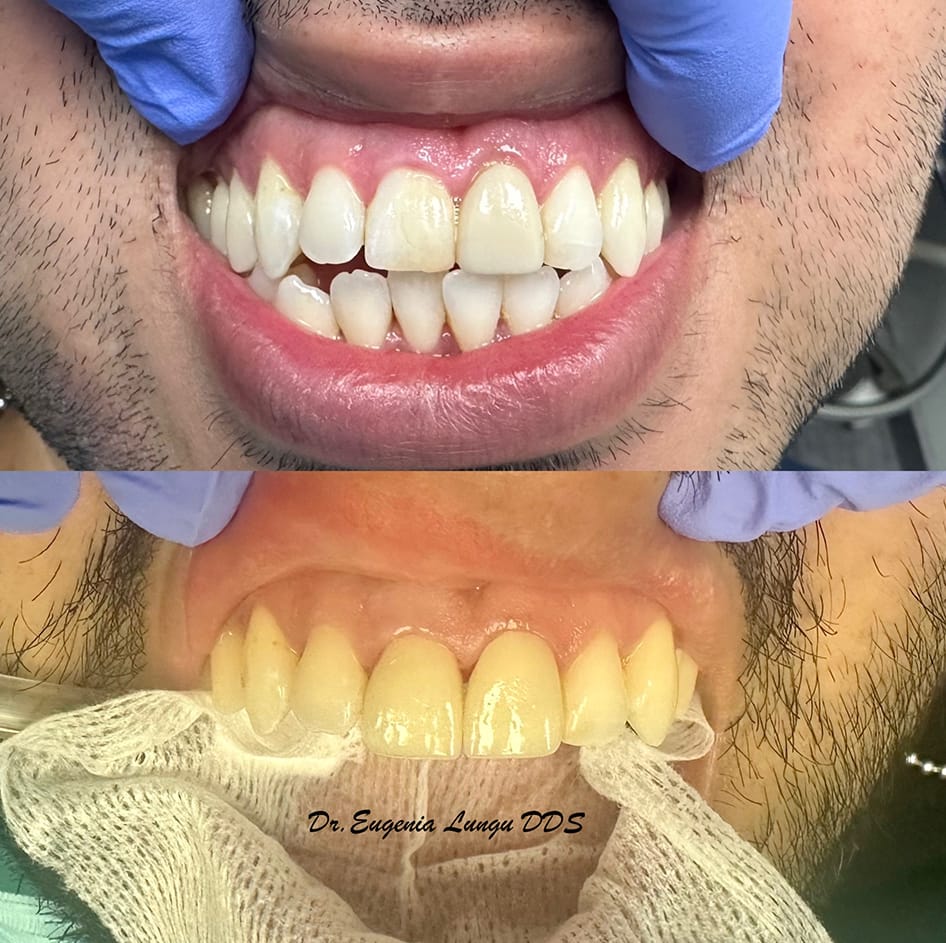 Before and after dental bleaching