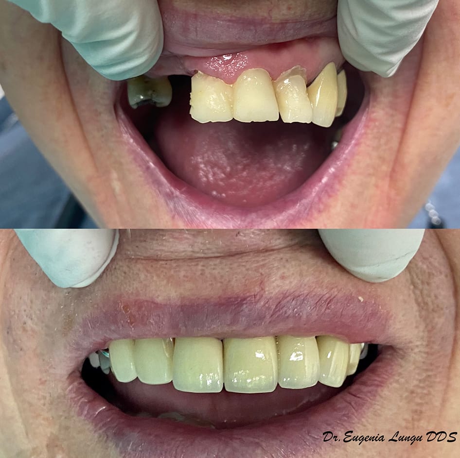 Before and after full mouth restoration
