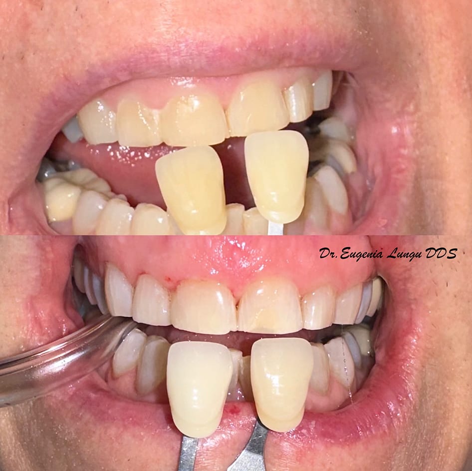 Before and after tooth bleaching