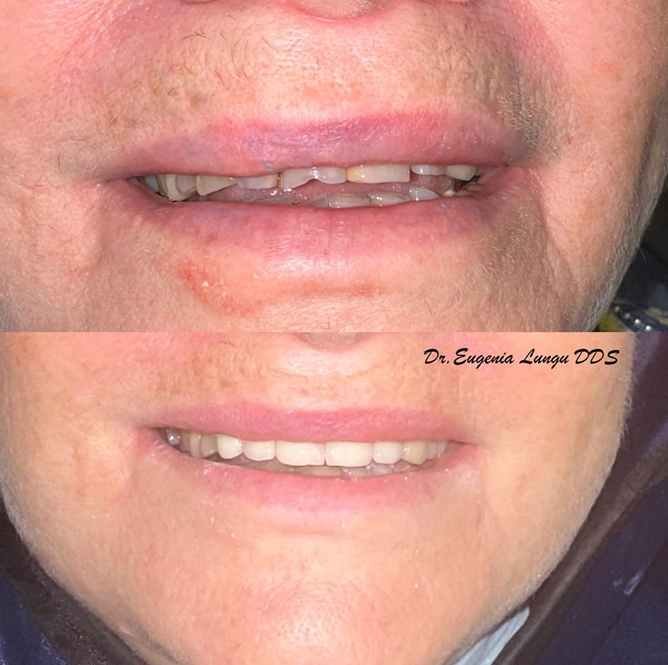 Before and after full mount rehab