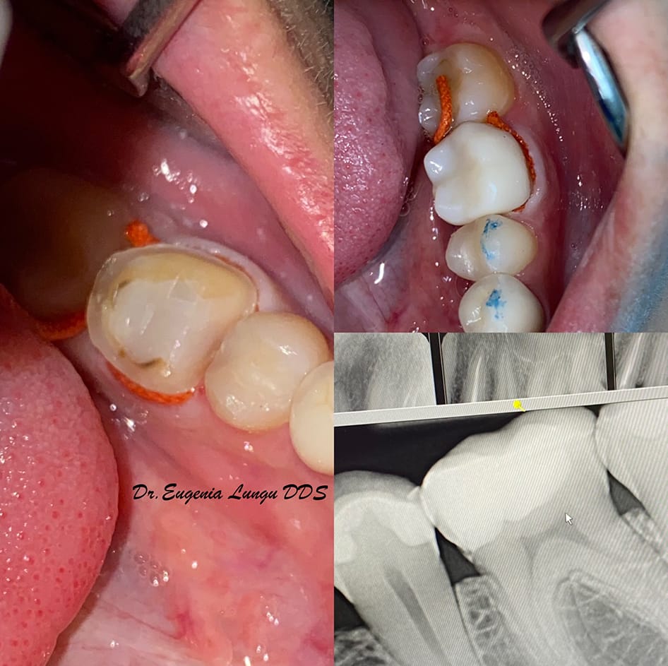 Before and after dental crown