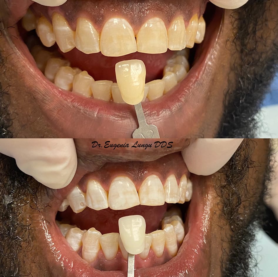 Before and after teeth bleaching