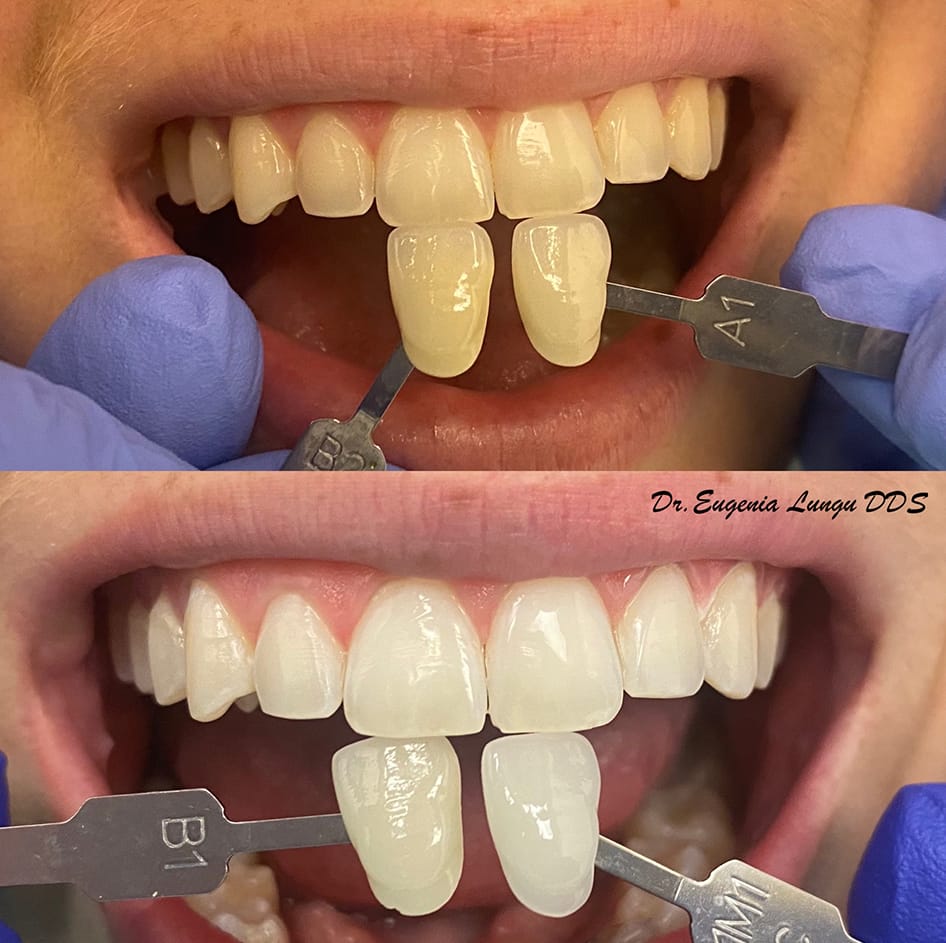Before and after teeth whitening