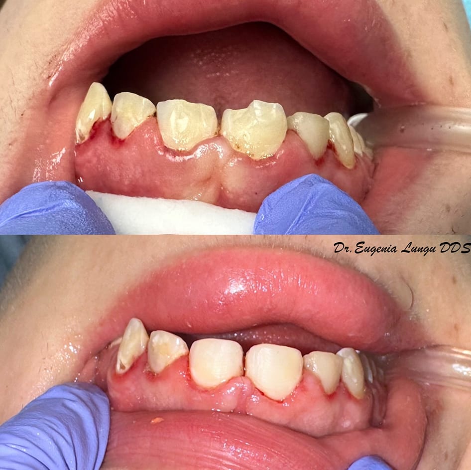 Before and after full arch restoration