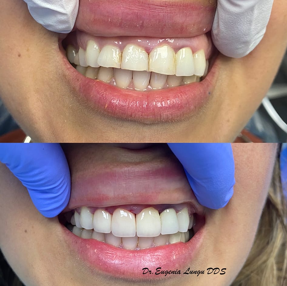 Full mouth rehabilitation before and after