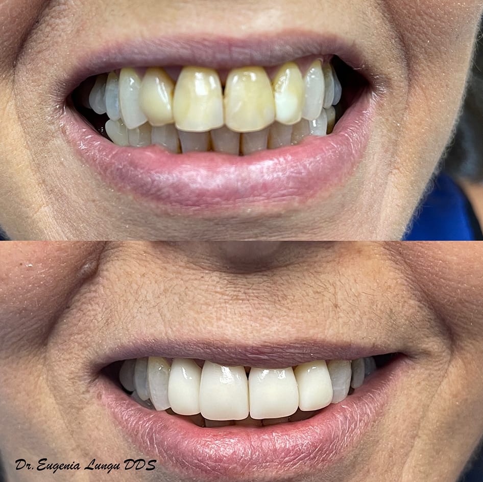 Before and after professional teeth whitening