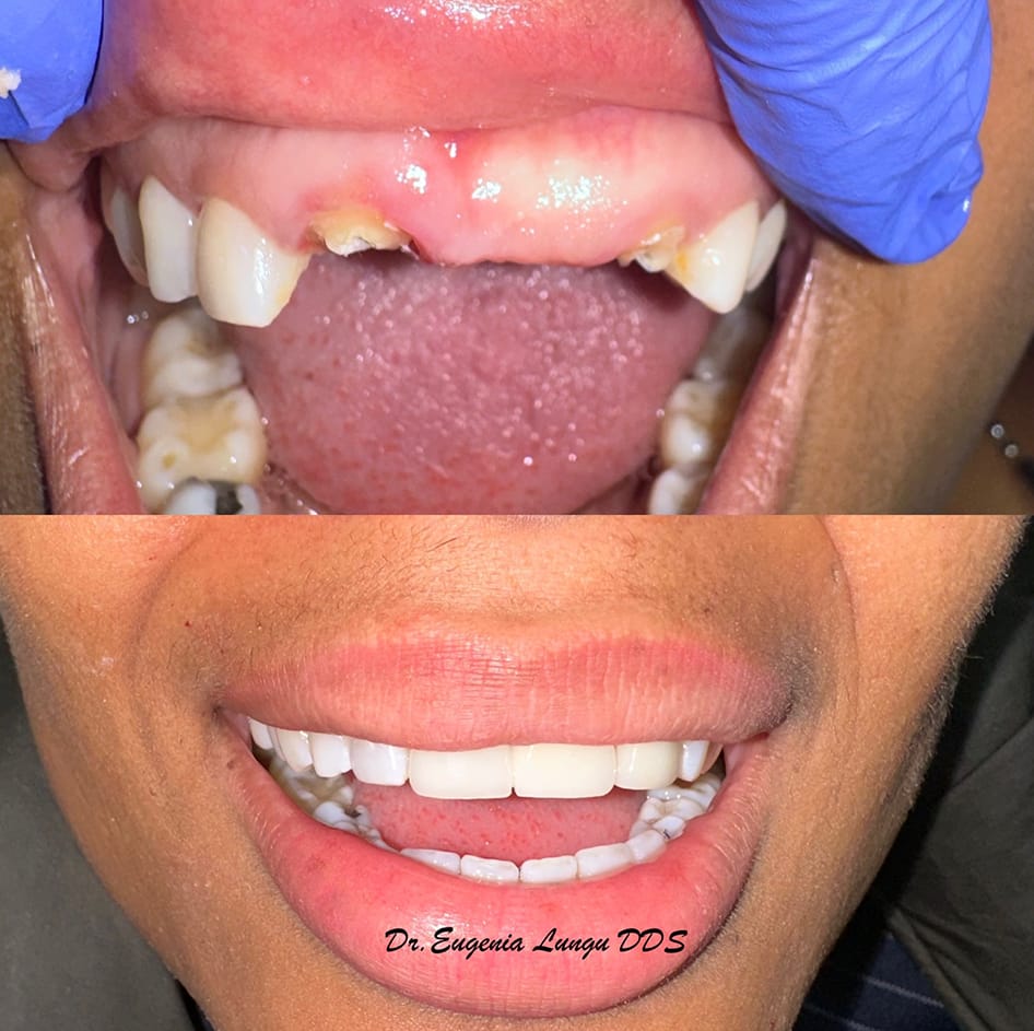Before and after front tooth dental implants