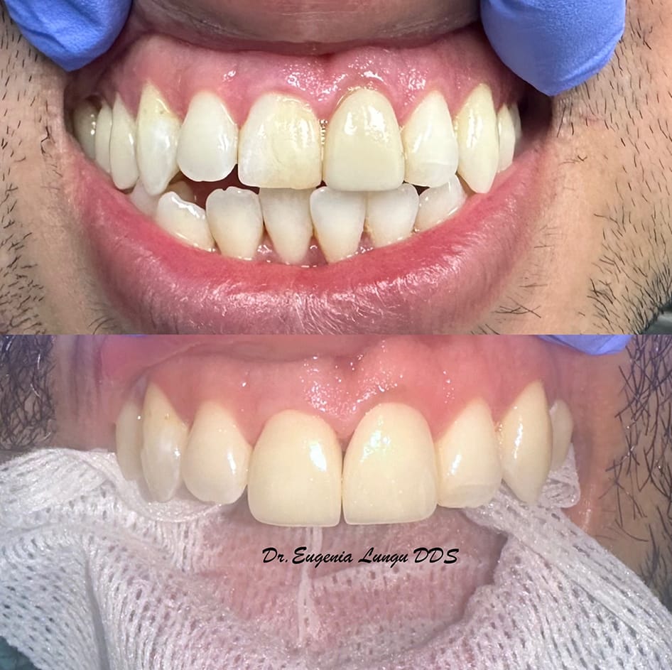Before and after clinical tooth whitening