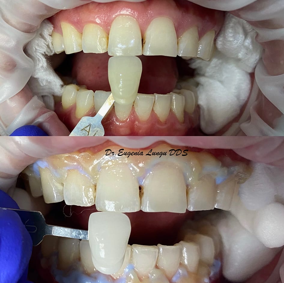 Before and after tooth whitening