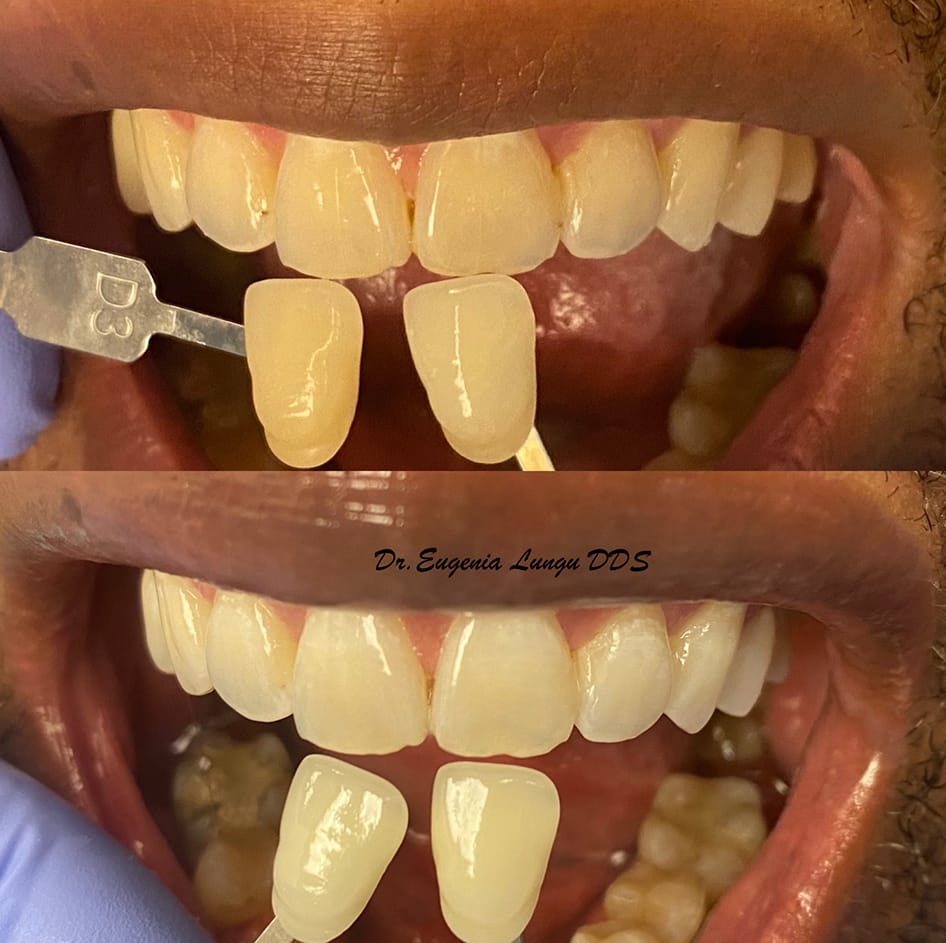 Teeth whitening before and after results