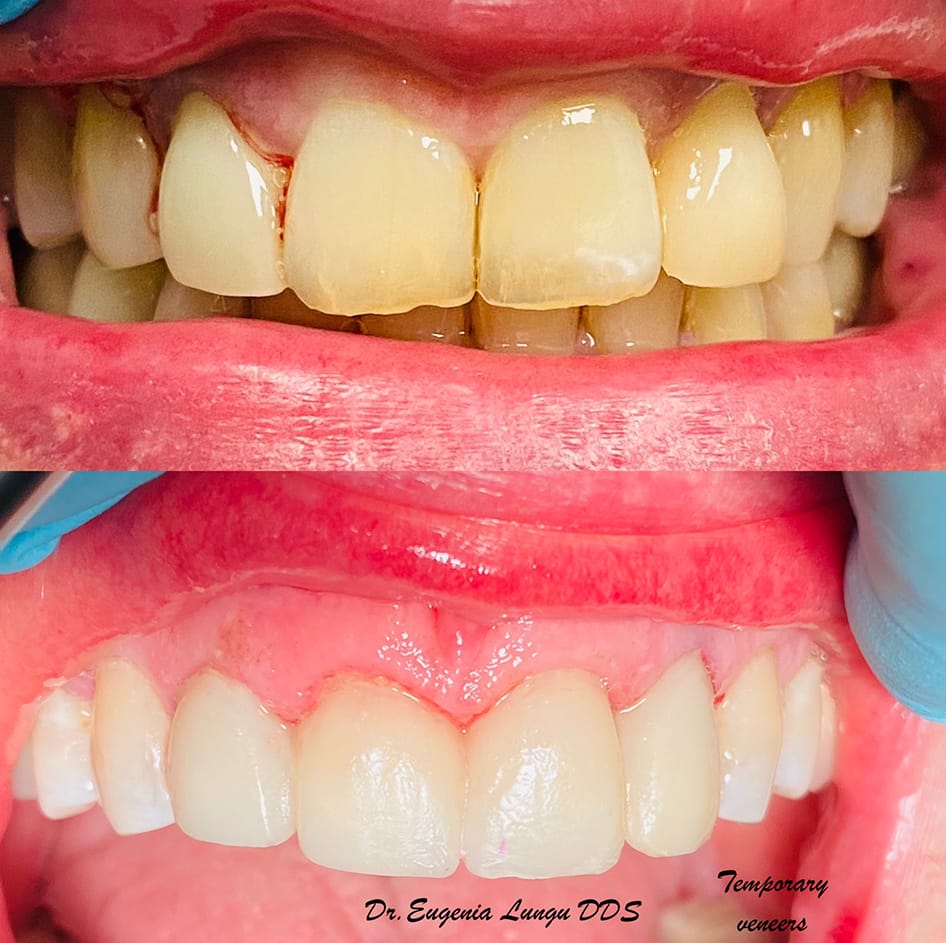 Before and after teeth whitening treatment